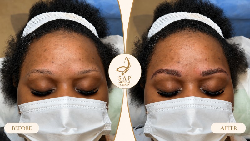 Eyebrow transplant Fue sap medical group