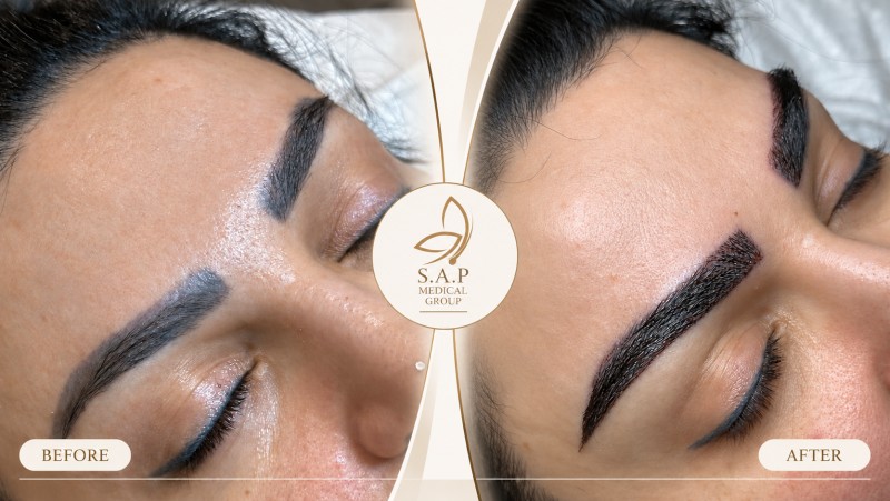 MFUT Eyebrow Transplant method sap medical group (1)