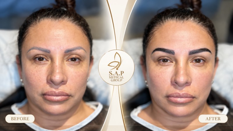MFUT Eyebrow Transplant method sap medical group (4)