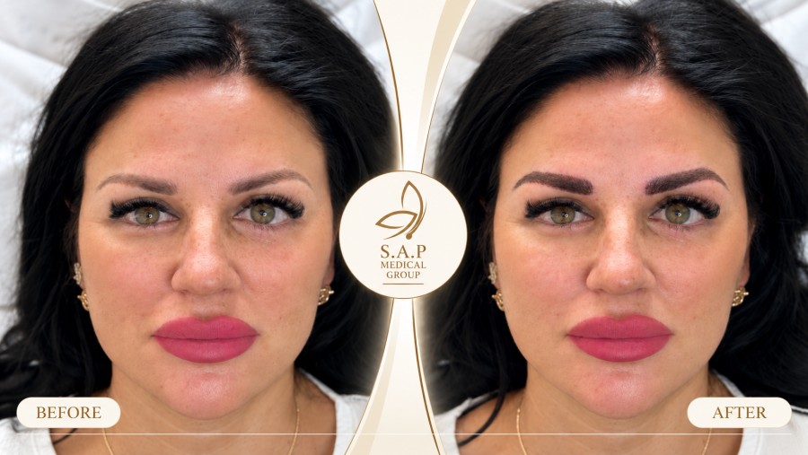 MFUT Eyebrow Transplant method sap medical group (6)
