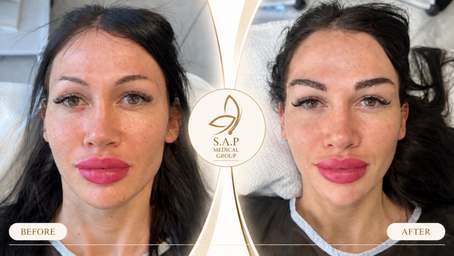 MFUT Eyebrow Transplant method sap medical group (7)