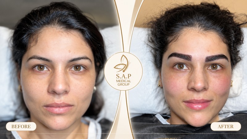 MFUT Eyebrow Transplant method sap medical group 8