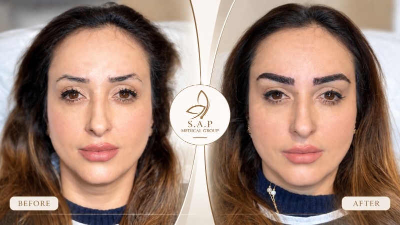 MFUT Eyebrow Transplant method sap medical group