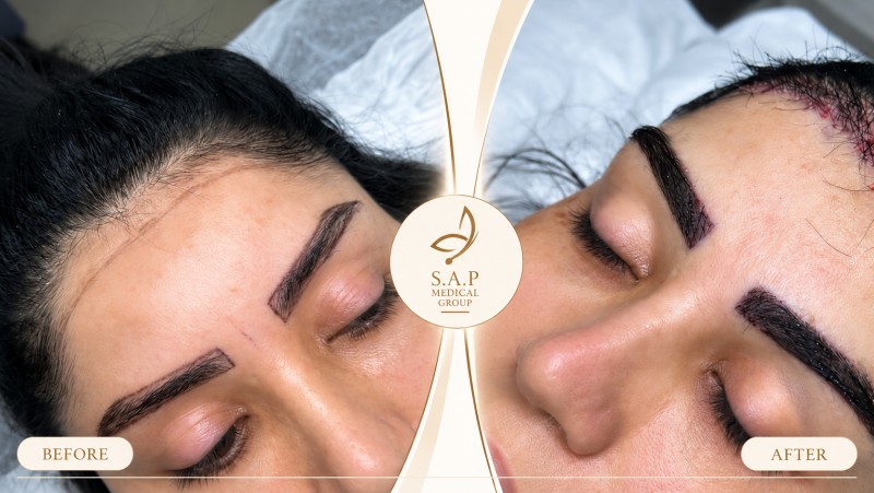 MFUT hair line &eyebrows